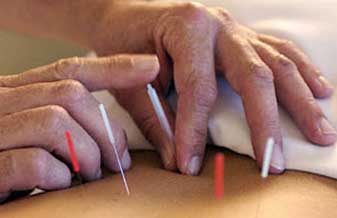 Neotrauma Acupuntura - Foto 1